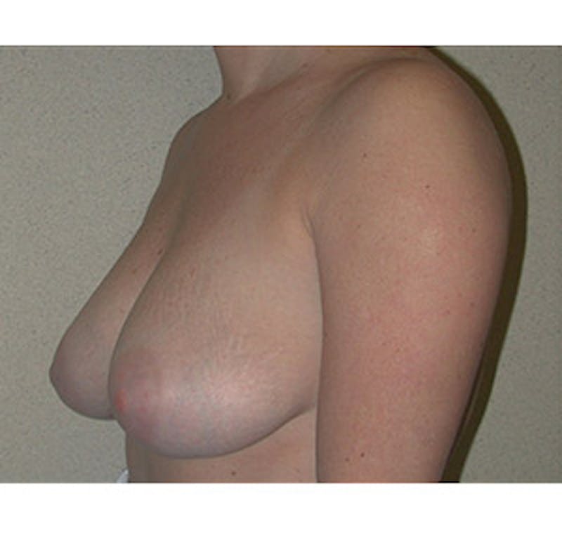 Breast Lift Before & After Gallery - Patient 122054729 - Image 5