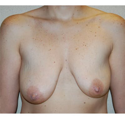 Breast Lift Before & After Gallery - Patient 122054730 - Image 1