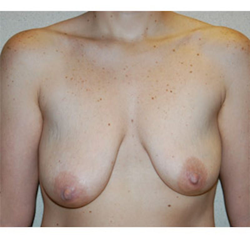Breast Lift Before & After Gallery - Patient 122054730 - Image 1