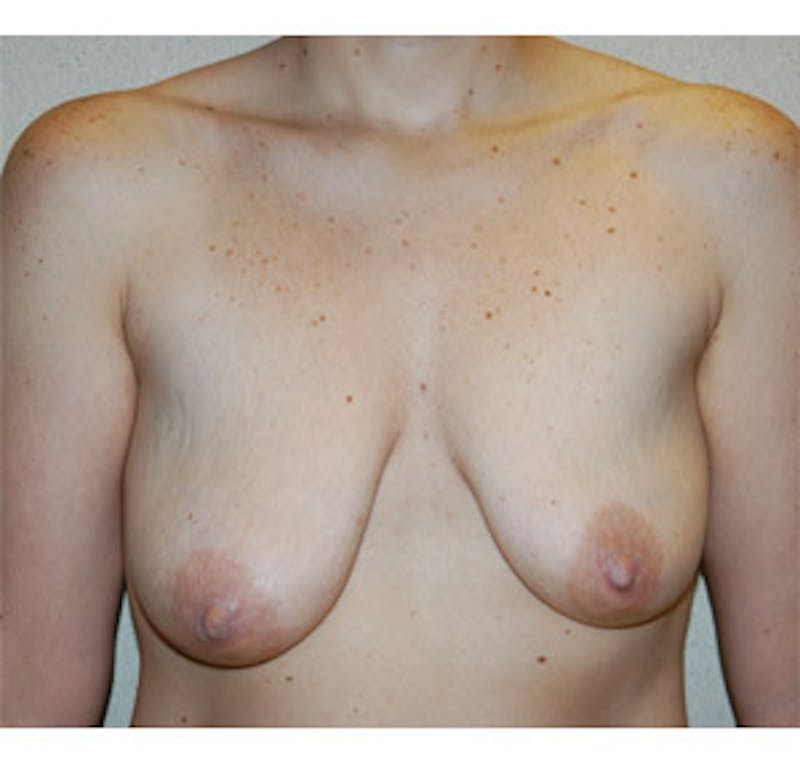 Breast Lift Before & After Gallery - Patient 122054730 - Image 1