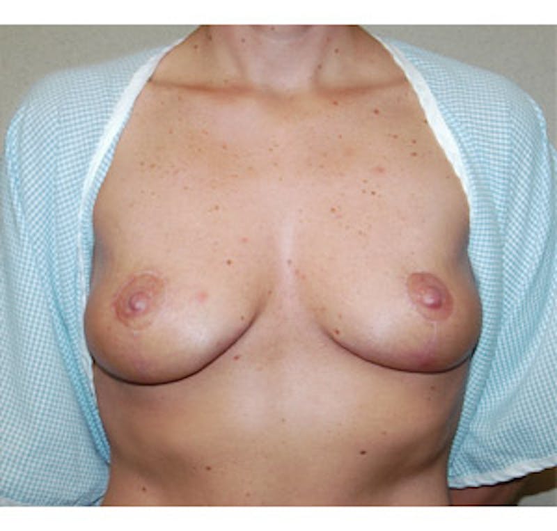 Breast Lift Before & After Gallery - Patient 122054730 - Image 2