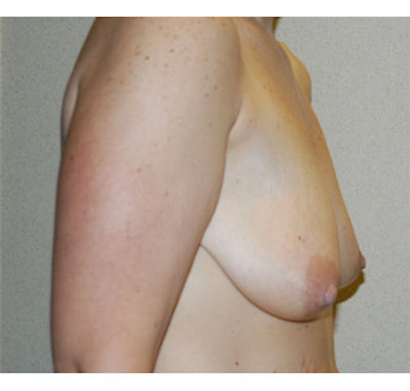 Breast Lift Before & After Gallery - Patient 122054730 - Image 3