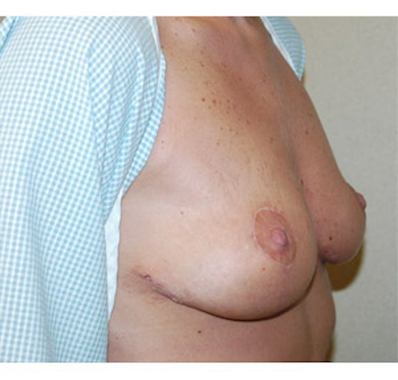 Breast Lift Before & After Gallery - Patient 122054730 - Image 4