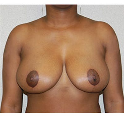 Breast Reduction Before & After Gallery - Patient 122054770 - Image 2