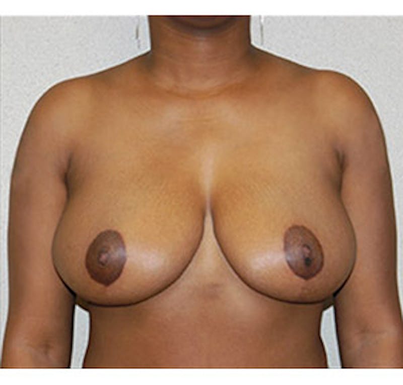 Breast Reduction Before & After Gallery - Patient 122054770 - Image 2