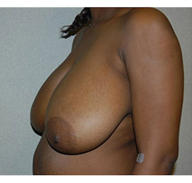 Breast Reduction Before & After Gallery - Patient 122054770 - Image 3