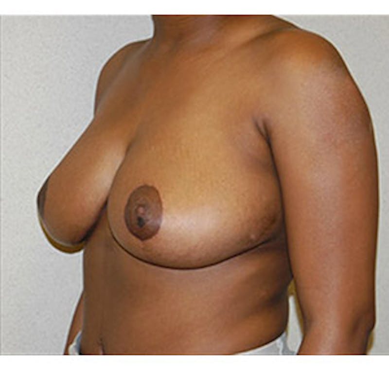 Breast Reduction Before & After Gallery - Patient 122054770 - Image 4