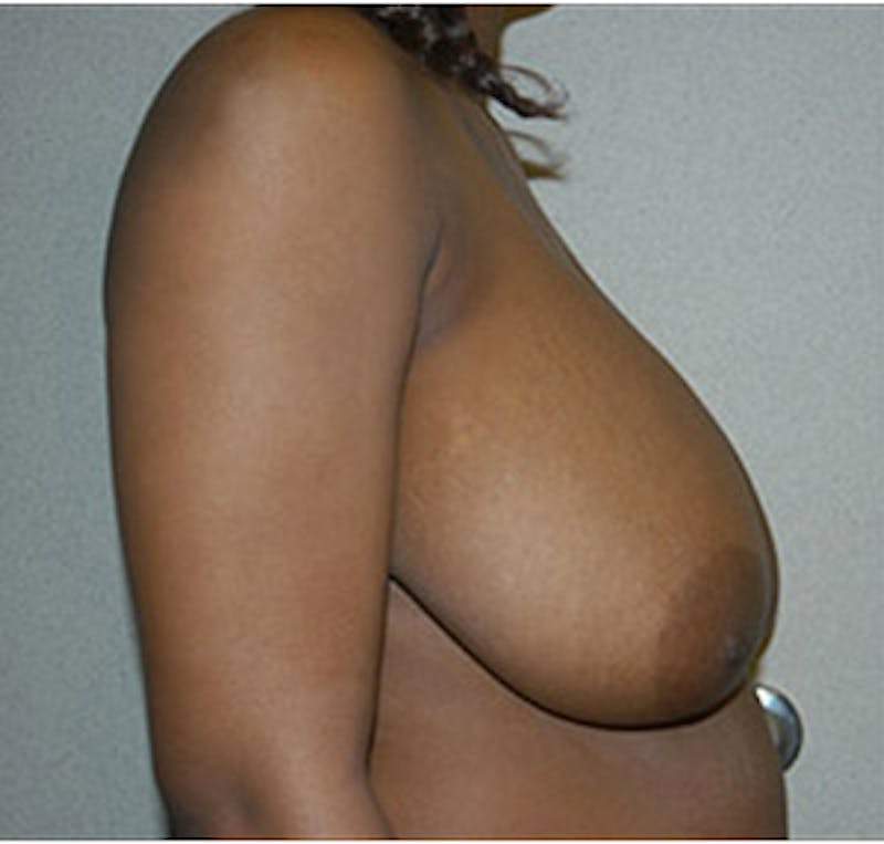 Breast Reduction Before & After Gallery - Patient 122054770 - Image 5