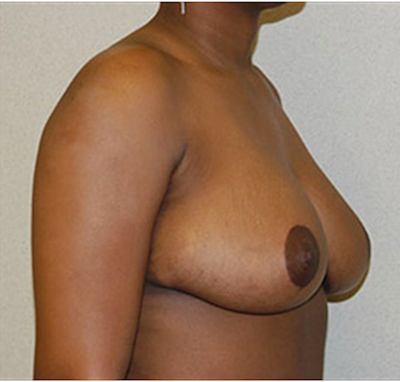 Breast Reduction Before & After Gallery - Patient 122054770 - Image 6