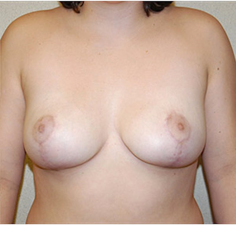 Breast Reduction Before & After Gallery - Patient 122054771 - Image 2