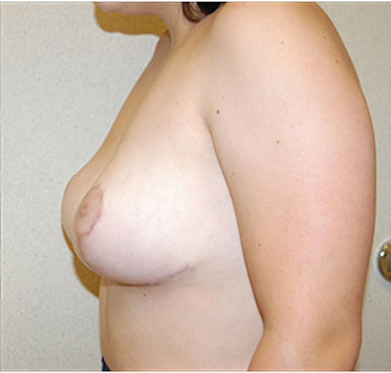 Breast Reduction Before & After Gallery - Patient 122054771 - Image 4