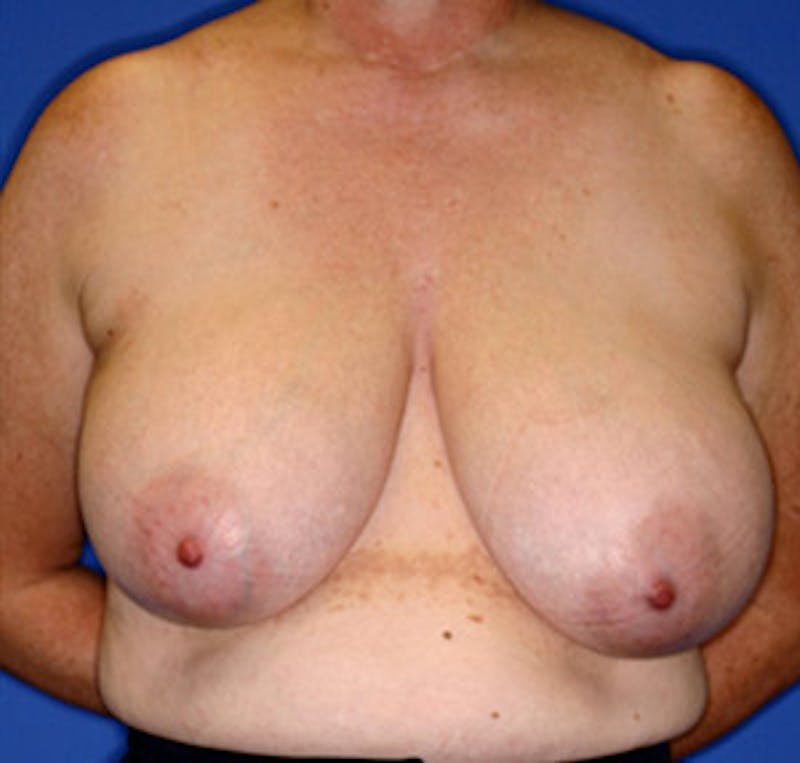 Breast Reduction Before & After Gallery - Patient 122054781 - Image 1
