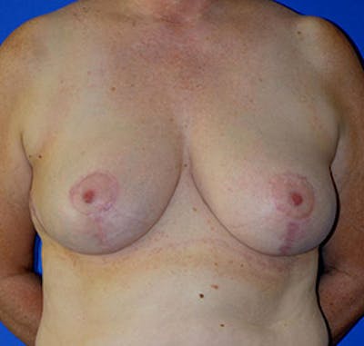 Breast Reduction Before & After Gallery - Patient 122054781 - Image 2
