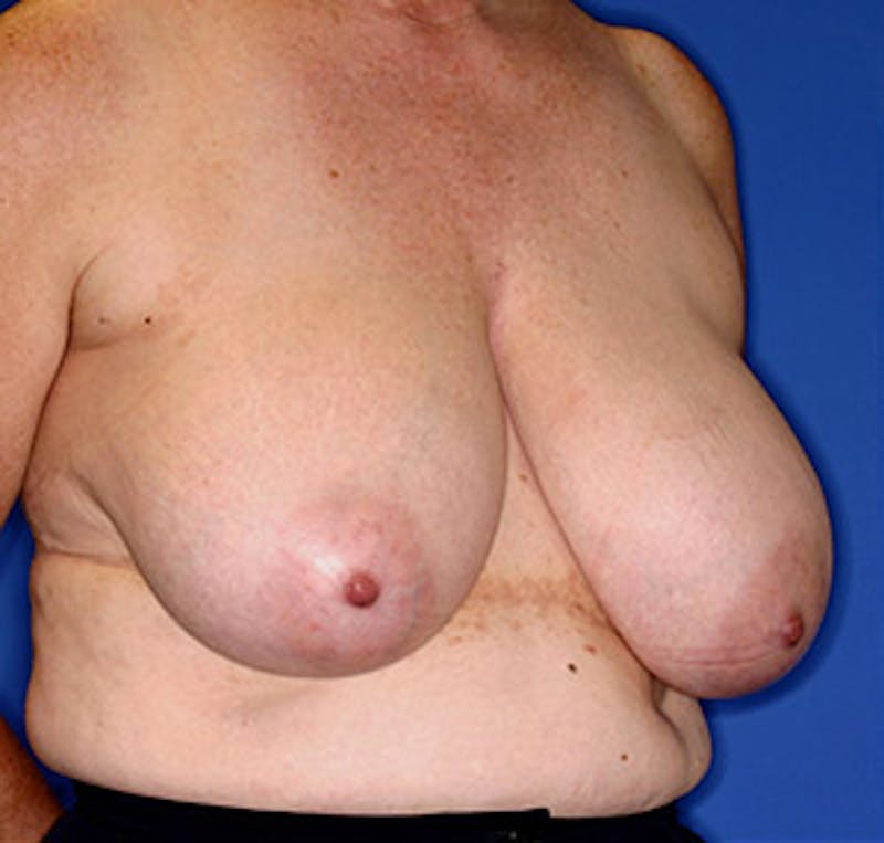 Breast Reduction Before & After Gallery - Patient 122054781 - Image 3