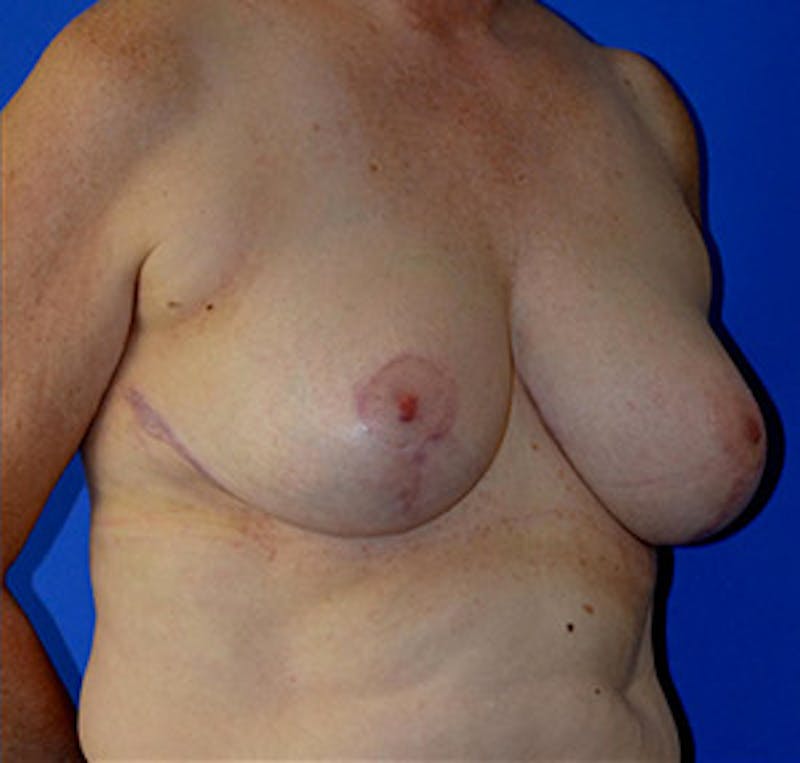 Breast Reduction Before & After Gallery - Patient 122054781 - Image 4