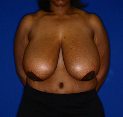 Breast Reduction Before & After Gallery - Patient 122054782 - Image 1