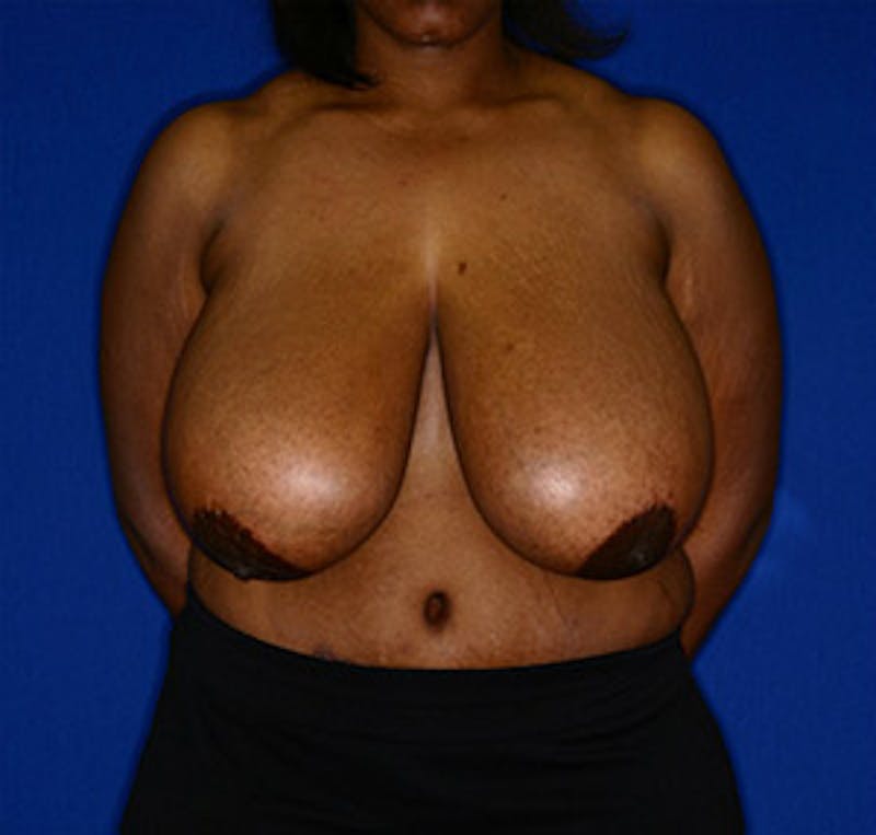 Breast Reduction Before & After Gallery - Patient 122054782 - Image 1