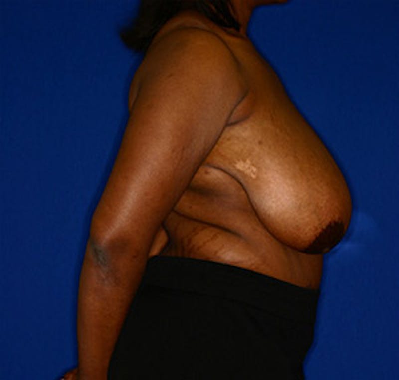 Breast Reduction Before & After Gallery - Patient 122054782 - Image 3