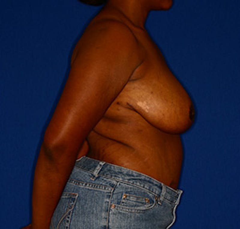 Breast Reduction Before & After Gallery - Patient 122054782 - Image 4