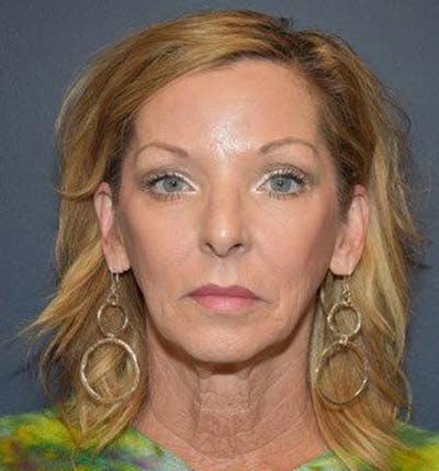 Facelift Before & After Gallery - Patient 122054789 - Image 1