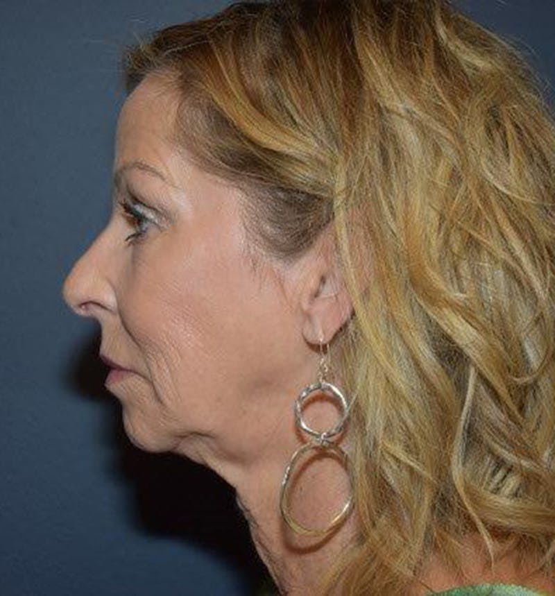 Facelift Before & After Gallery - Patient 122054789 - Image 3