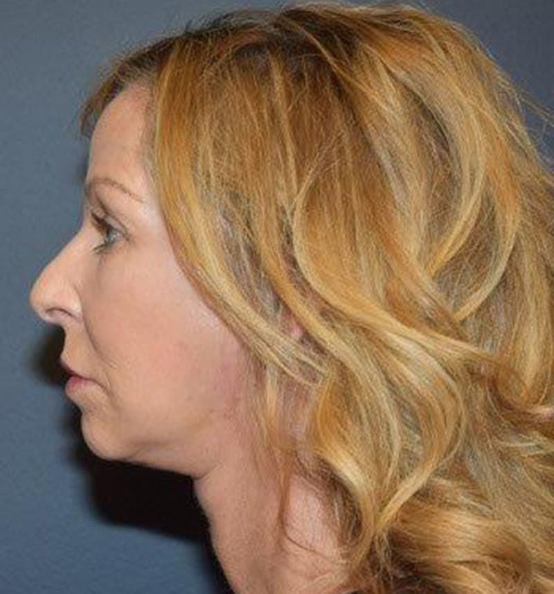 Facelift Before & After Gallery - Patient 122054789 - Image 4