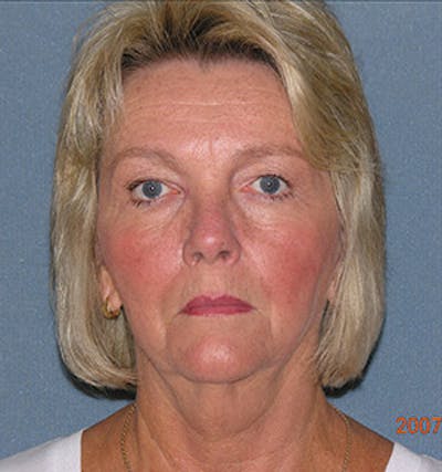 Facelift Before & After Gallery - Patient 122054790 - Image 1