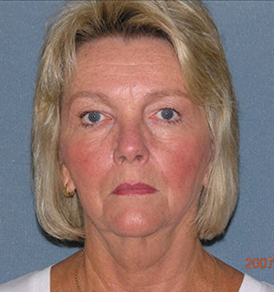 Facelift Before & After Gallery - Patient 122054790 - Image 1