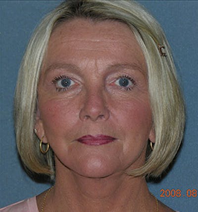 Facelift Before & After Gallery - Patient 122054790 - Image 2