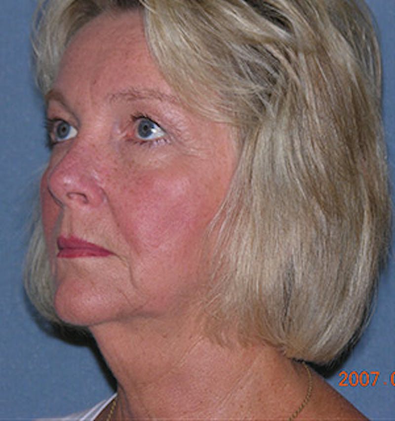 Facelift Before & After Gallery - Patient 122054790 - Image 3
