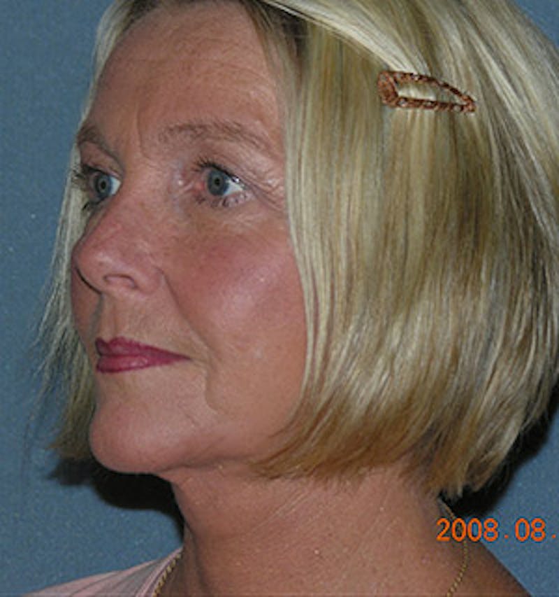 Facelift Before & After Gallery - Patient 122054790 - Image 4