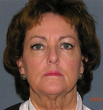 Facelift Before & After Gallery - Patient 122054791 - Image 1