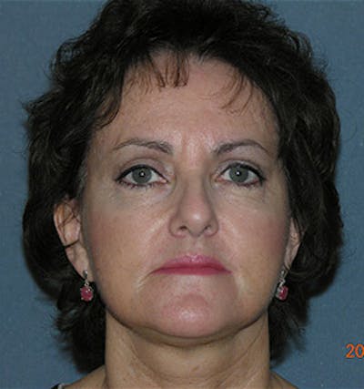 Facelift Before & After Gallery - Patient 122054791 - Image 2