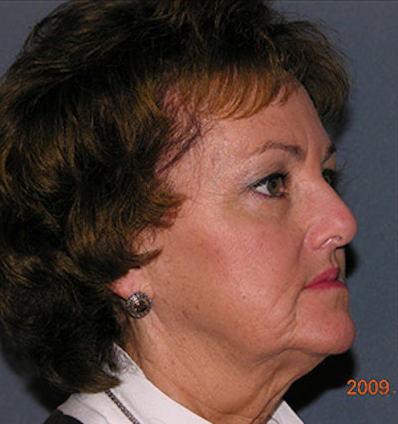 Facelift Before & After Gallery - Patient 122054791 - Image 3