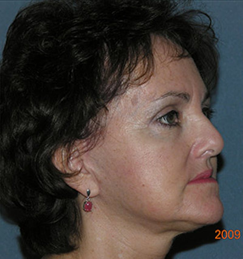 Facelift Before & After Gallery - Patient 122054791 - Image 4