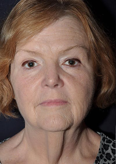 Facelift Before & After Gallery - Patient 122054792 - Image 1