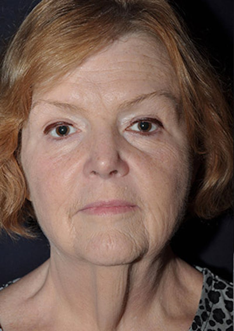 Facelift Before & After Gallery - Patient 122054792 - Image 1