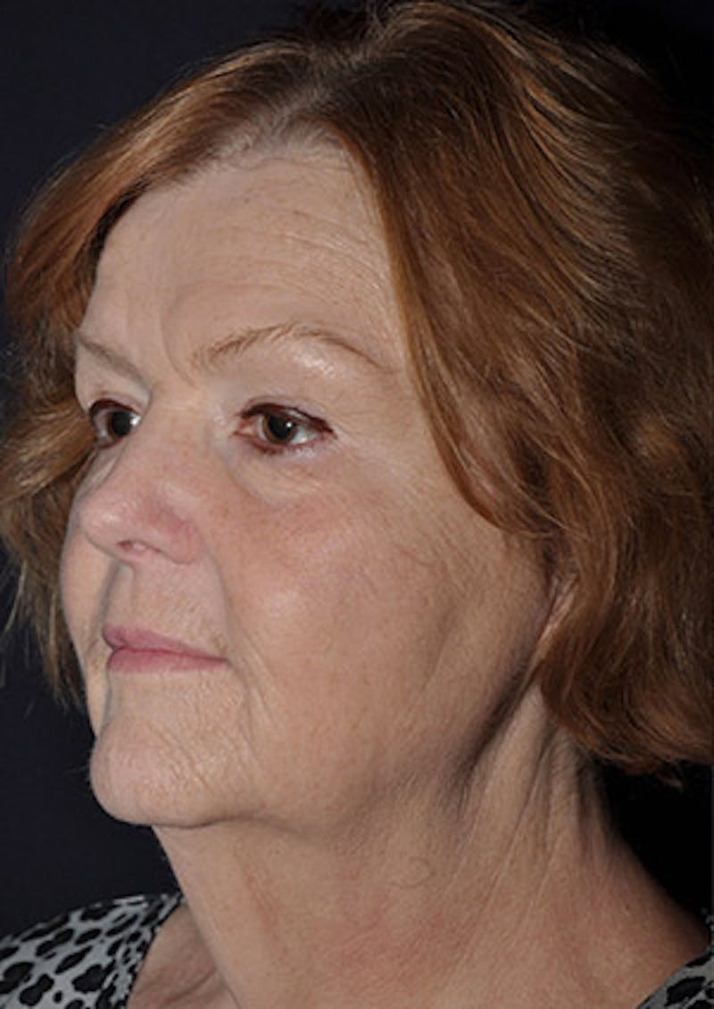 Facelift Before & After Gallery - Patient 122054792 - Image 3