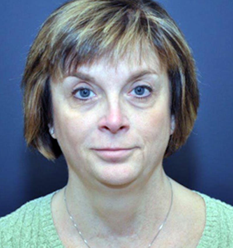 Facelift Before & After Gallery - Patient 122054793 - Image 1