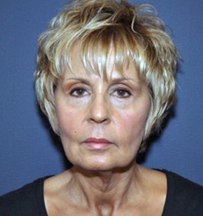 Facelift Before & After Gallery - Patient 122054799 - Image 1