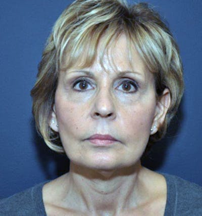 Facelift Before & After Gallery - Patient 122054799 - Image 2