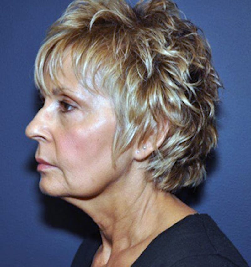Facelift Before & After Gallery - Patient 122054799 - Image 3