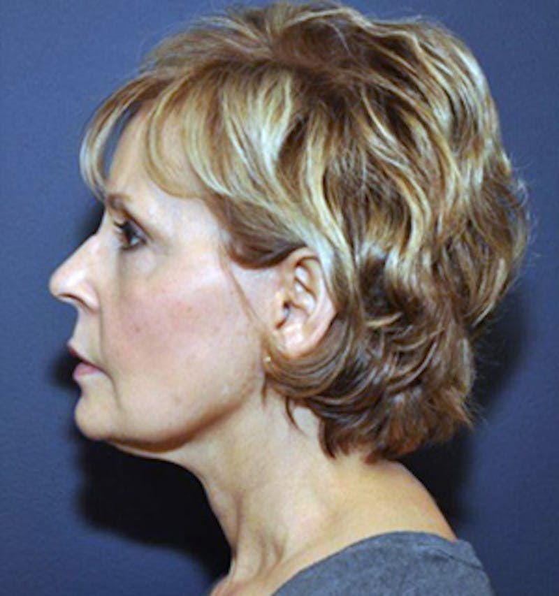 Facelift Before & After Gallery - Patient 122054799 - Image 4