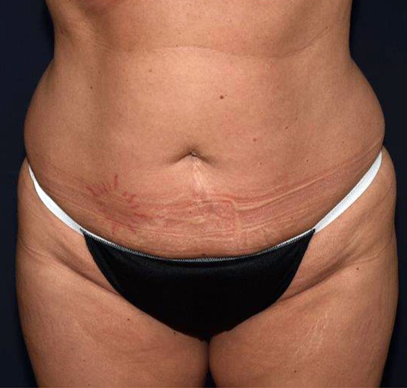 Tummy Tuck Before & After Gallery - Patient 122054801 - Image 1