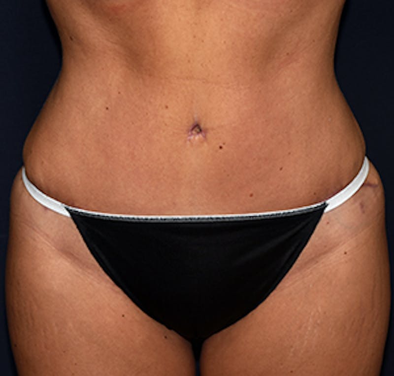 Tummy Tuck Before & After Gallery - Patient 122054801 - Image 2