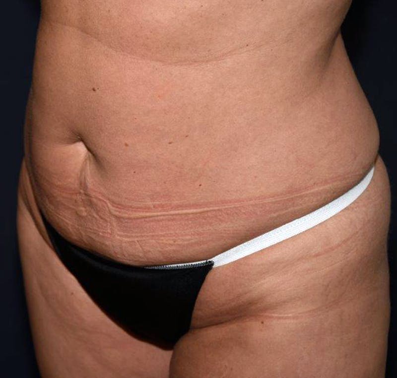 Tummy Tuck Before & After Gallery - Patient 122054801 - Image 3