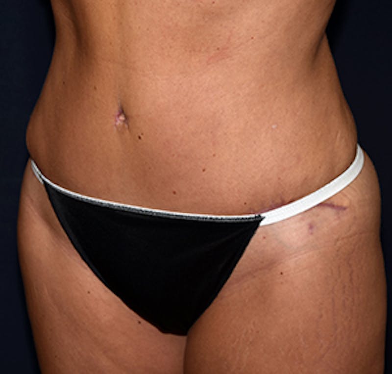 Tummy Tuck Before & After Gallery - Patient 122054801 - Image 4