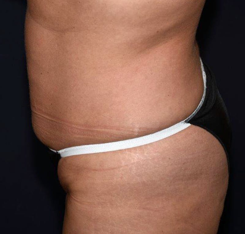 Tummy Tuck Before & After Gallery - Patient 122054801 - Image 5