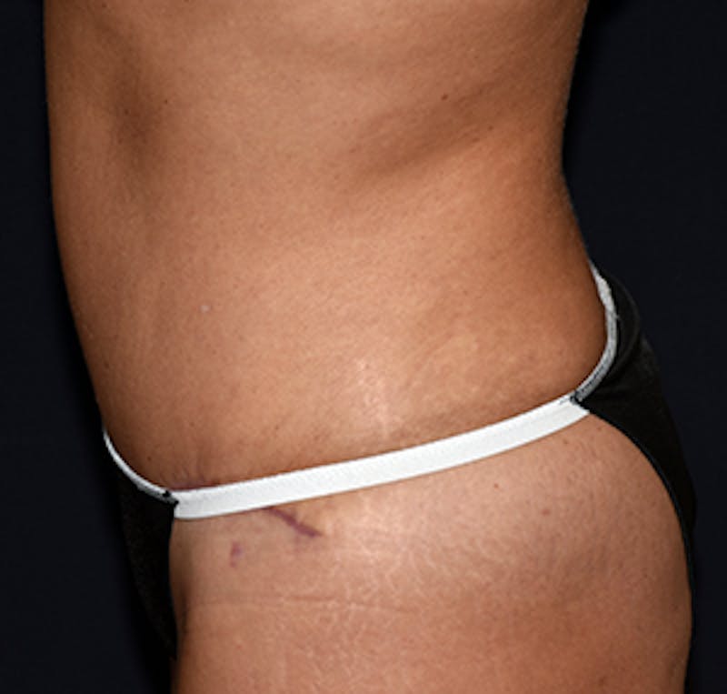 Tummy Tuck Before & After Gallery - Patient 122054801 - Image 6