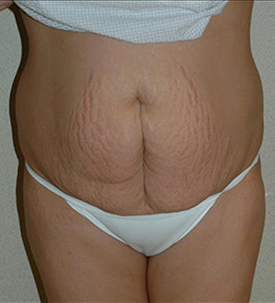 Tummy Tuck Before & After Gallery - Patient 122054812 - Image 1